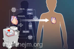 O nouă metodă de transplant ar putea extinde oferta de inimi provenite de la donatori (studiu)