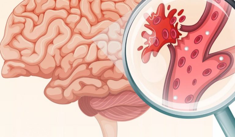 Fibrilația atrială crește riscul de accident vascular cerebral de 4 ori