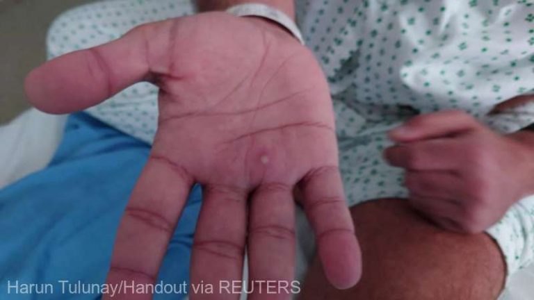 Peru anunţă primul deces al unui pacient infectat cu variola maimuţei