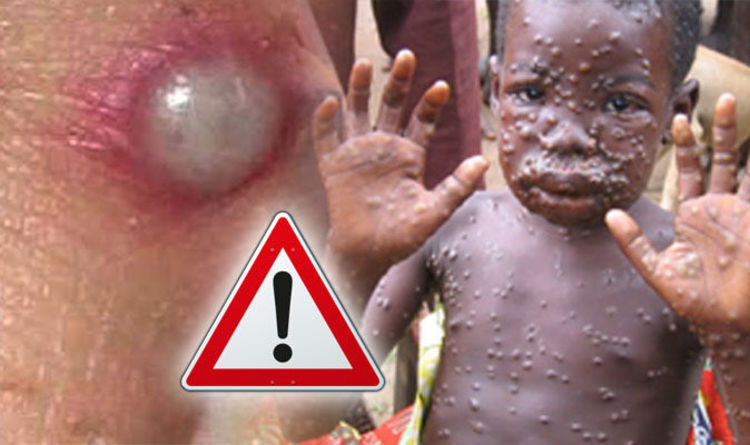 Cazurile de variola maimuţei din UK, asociate unei variante mai puţin grave