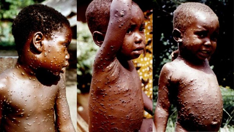 În Africa au fost izolate mai multe focare de variola maimuţei în timpul pandemiei de coronavirus
