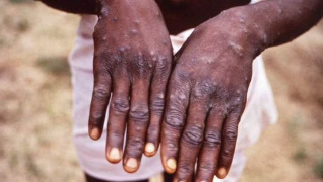 Tot mai multe cazuri de variola maimuţei se anunţă peste tot în lume