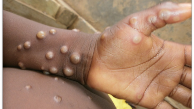 Chinezii sunt sfătuiţi să NU se atingă de străini pentru a evita îmbolnăvirea cu variola maimuţei