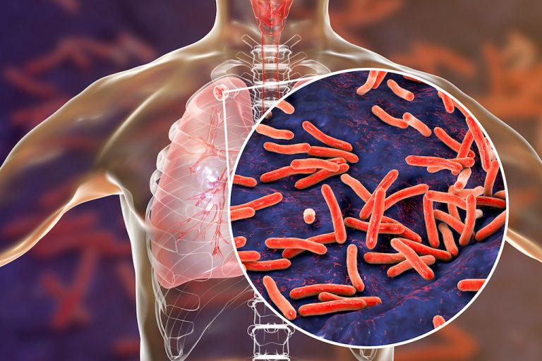 Numărul deceselor cauzate de tuberculoză, a crescut din nou din cauza pandemiei de COVID-19 (OMS)